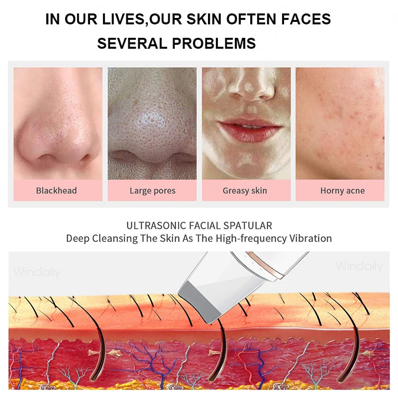 Espátula Facial Ultrasónica — Limpieza Profunda y Anti-Puntos Negros