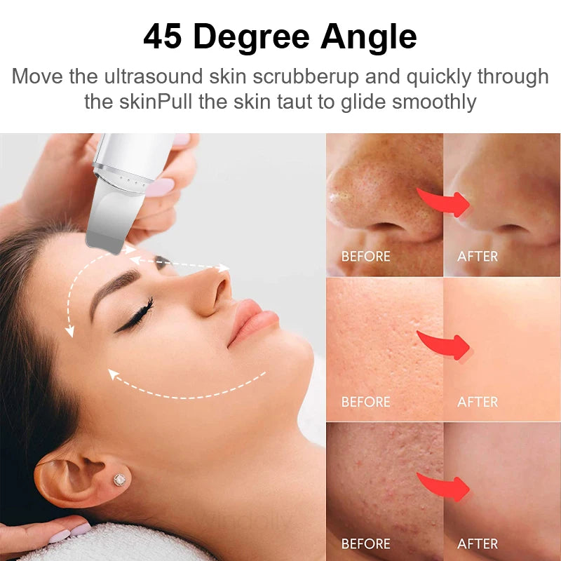 Espátula Facial Ultrasónica — Limpieza Profunda y Anti-Puntos Negros